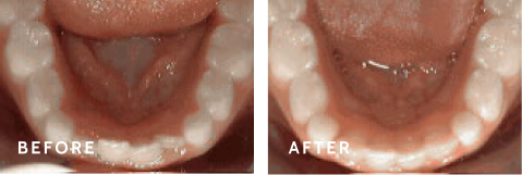 Achieve Your Best Smile – Before & After Success with Orthodontics Treatment. Before after photos of front teeth before and after Non-braces treatment procedures